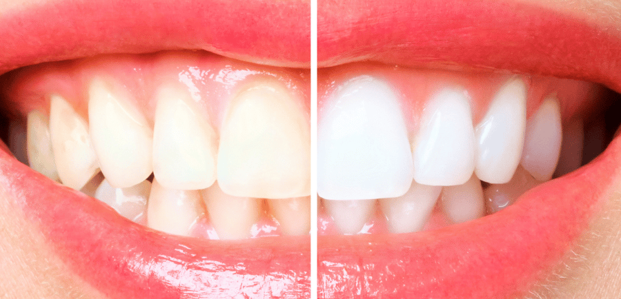 A bright and healthy smile achieved through professional tips from teeth whitening dentist