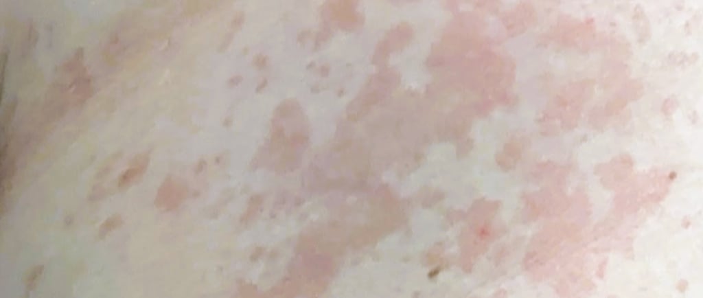 tinea versicolor on caucasian skin