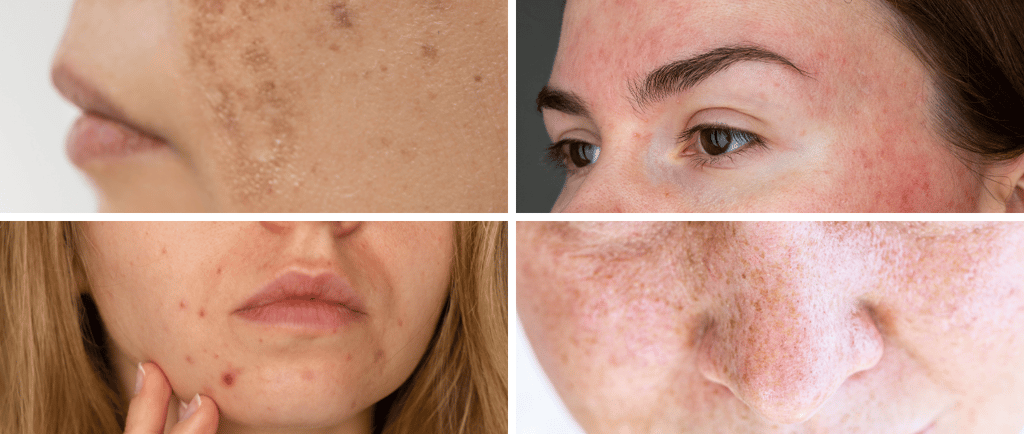a woman with freckered skin Melasma, high cortisol, acne, hyperpigmentation