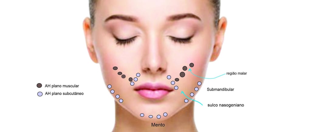 Cartografia facial com depósitos de Ácido Hialurônico