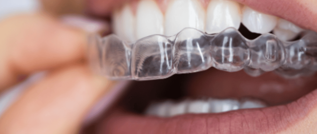 Clear Aligners - Dr. Marco Navarro Orashape