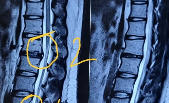 Disc prolapse occurs when a spinal disc bulges or ruptures, causing back pain, numbness, or weakness