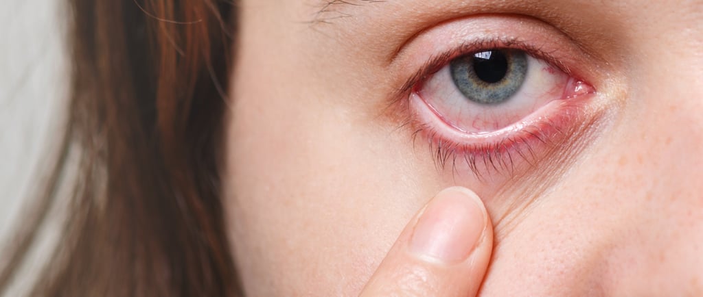 blepharitis dry eye bowmanville eye exam