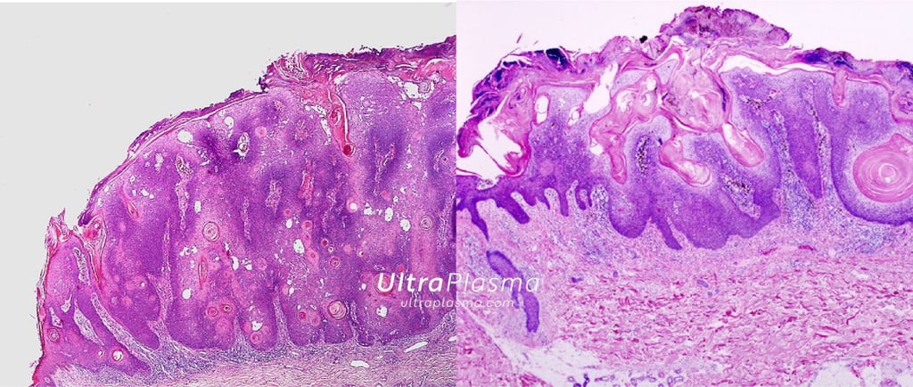 ultraplasma.com_seborrheik_keratosis_treatment_seboreik_keratoz_tedavisi_ultra_plasma_ultra_plazma
