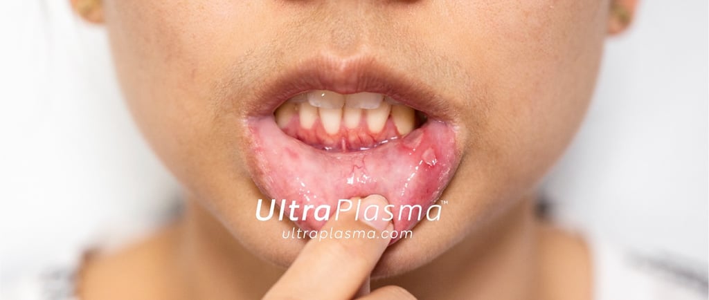 ultraplasma.com_aphthous-ulcer-or-canker-sore_treatment_ultra_plasma_ultra_plazma_ultra_plasma_ultra