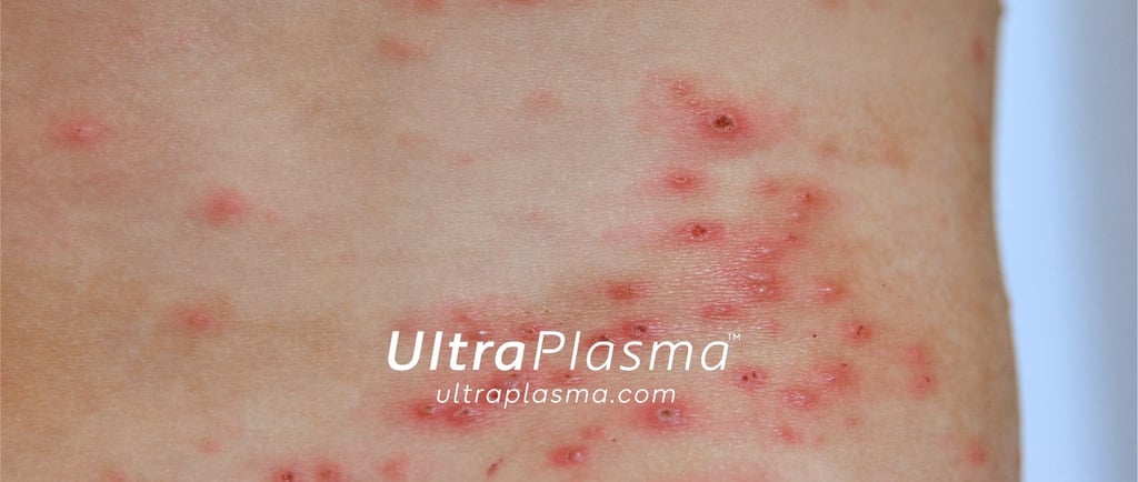 ultraplasma.com_chicken-pox-rash_treatment_su_cicegi_tedavi_ultra_plasma_ultra_plazma
