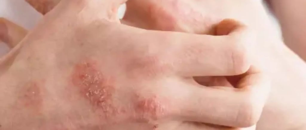 Close-up of a person's hands showing red, scaly skin patches indicative of psoriasis or eczema symptoms.