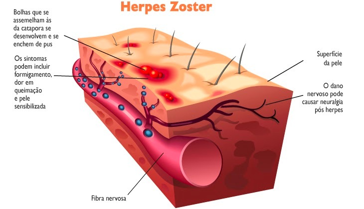 herpes zoster, dor neuropática, dor muscular