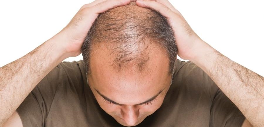 Quais os Melhores Suplementos para Queda de Cabelo