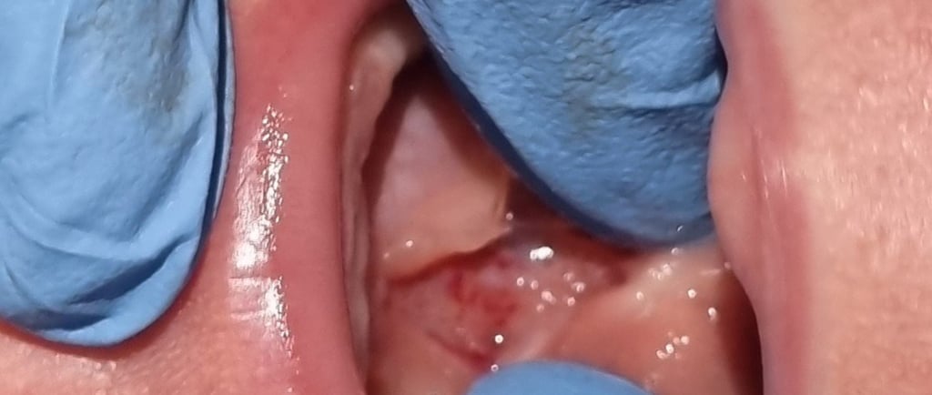 baby with tongue-tie division