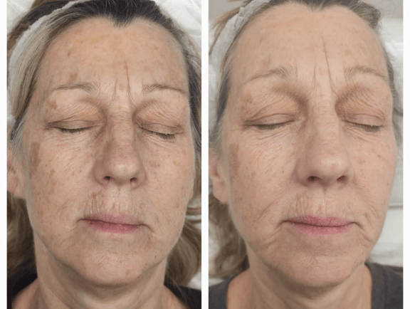 Before and after just 2 session of treatment at Ariana Esthetic Edmonton