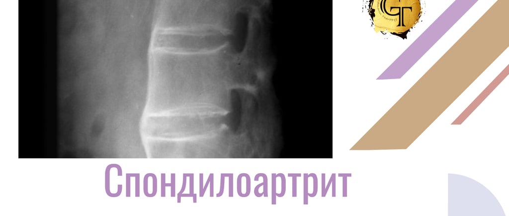 Спондилоартир снимка