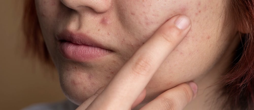 amabelle acne source & treatment