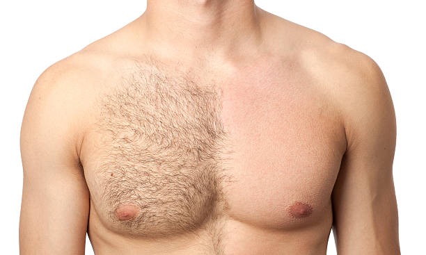 épilation laser homme