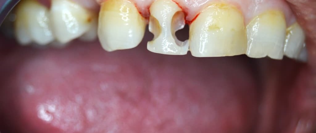 reconstruccion dental. clinica dental ades badajoz