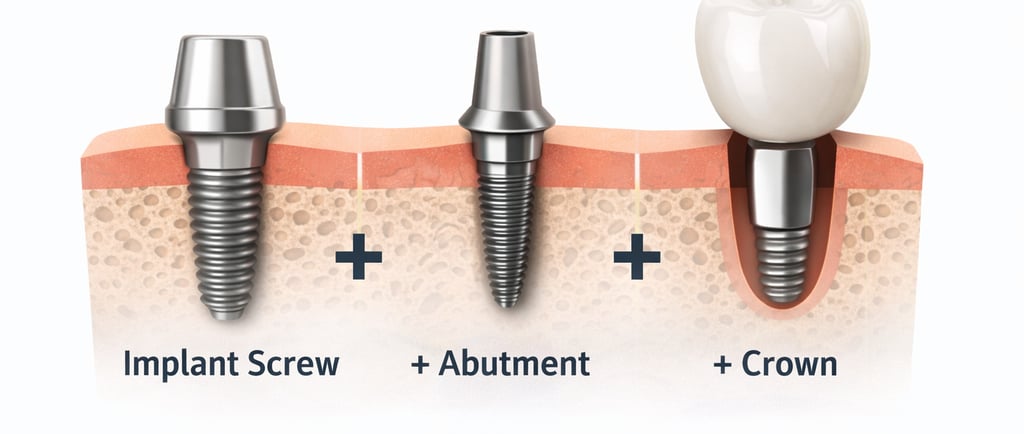 coste implantes dentales