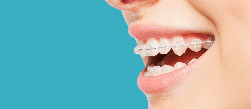 can braces fix an overbite?