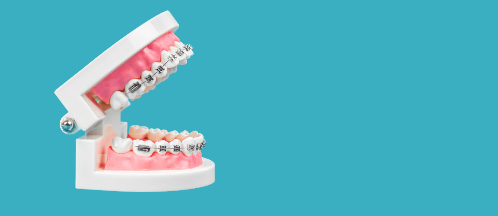crooked teeth in adults - understanding your options