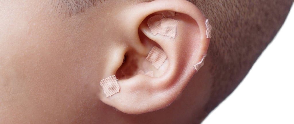 Auriculotherapy treatment using small adhesive ear seeds placed on specific acupuncture pressure points.