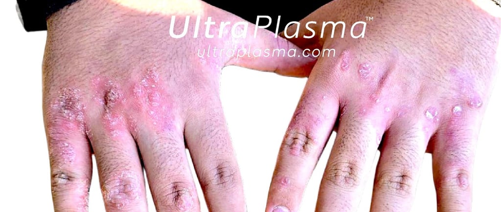 ultraplasma.com ultra plasma ultra plazma psoriasis sedef treatment tedavi