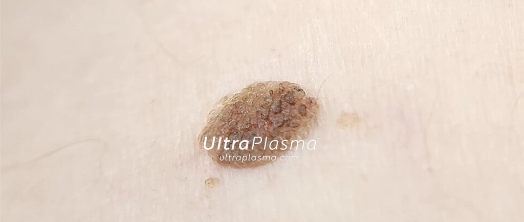 ultraplasma.com_seborrheik_keratosis_treatment_seboreik_keratoz_tedavisi_ultra_plasma_ultra_plazma