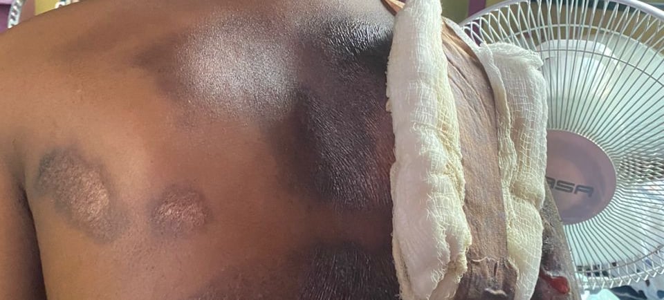 In the hospital. One of the lesbians with the wounds received from the beating by the mob.