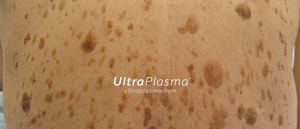 ultraplasma.com_seborrheik_keratosis_treatment_seboreik_keratoz_tedavisi_ultra_plasma_ultra_plazma
