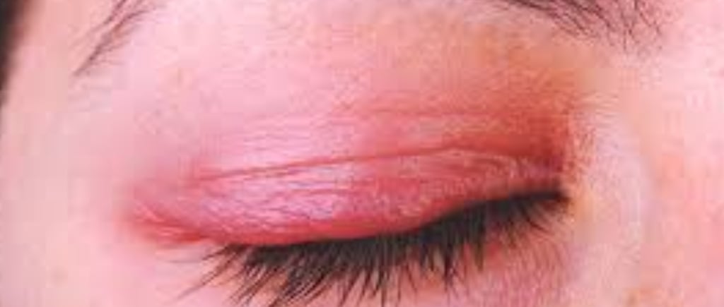 Watery eyes, dryness, itching, and burning in the eyes during fall and winter  Watery eyes, dryness,