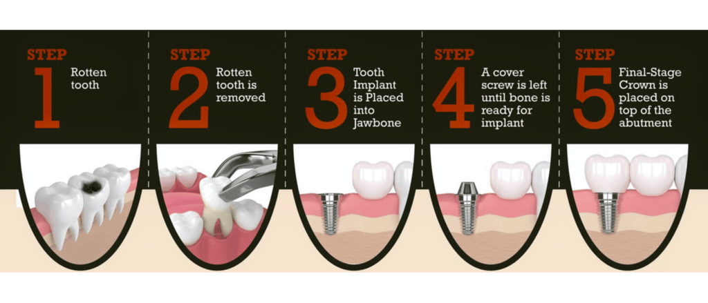 Dental Implant Procedure | Ekdantam dental clinic