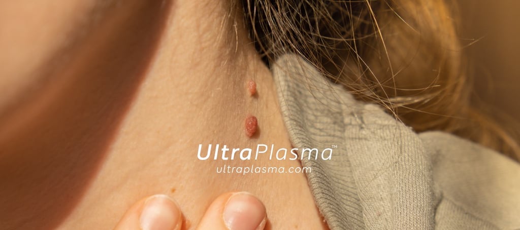 ultraplasma.com_skin_tag_removal_treatment_et_beni_temizleme_silme_tedavi_ultra_plasma_ultra_plazma