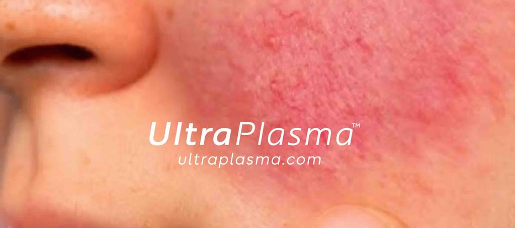 rosacea_roza_hastaligi_tedavi_treatment_ultra_plasma_ultra_plazma_ultra-plasma_ultra-plazma