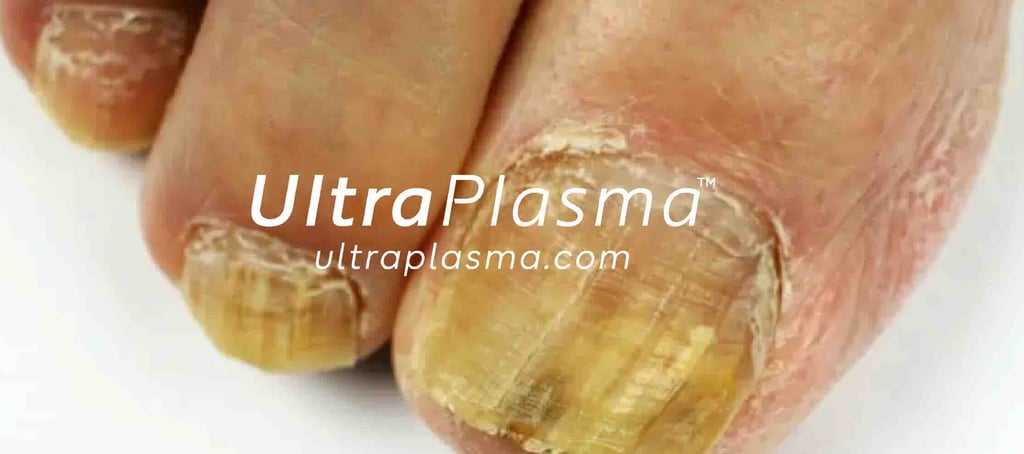 nail_fungus_onychomycosis_ultra_plasma_ultra_plazma_ultra-plasma_ultra-plazma