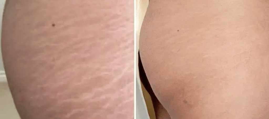 before after scar camouflage