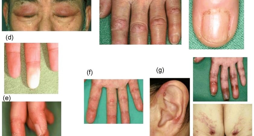 Interstitial Lung Disease: