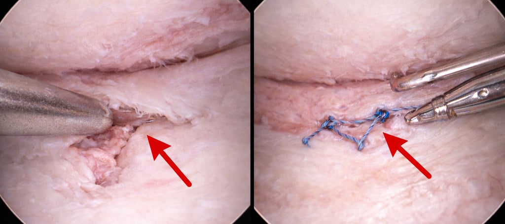 arthroscopie Réparation du ménisque lors d'une chirurgie