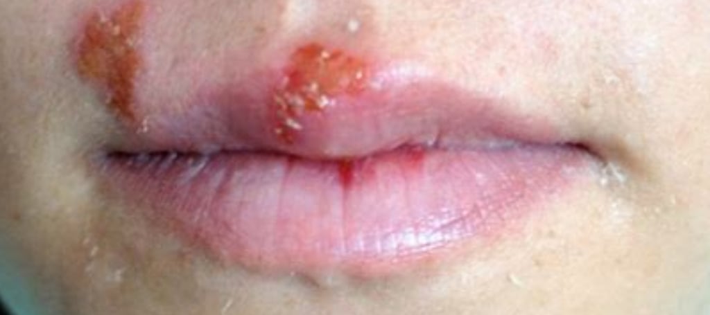🧪 Fasting & Honey: A Natural Approach to Herpes Management