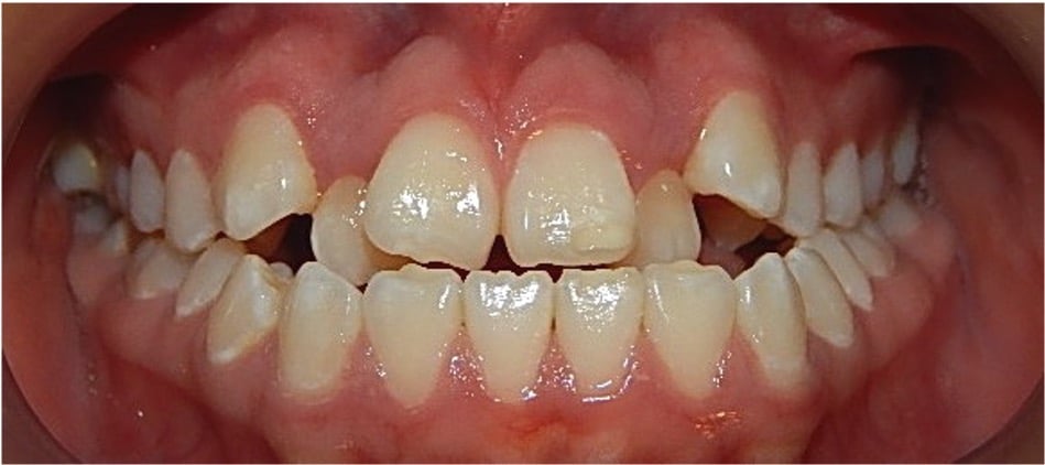 Close Up de una sonrisa con apiñamiento severo.