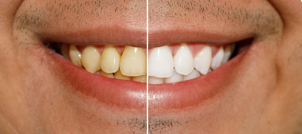 Before and after professional teeth whitening comparison showing yellow stains vs bright white smile.