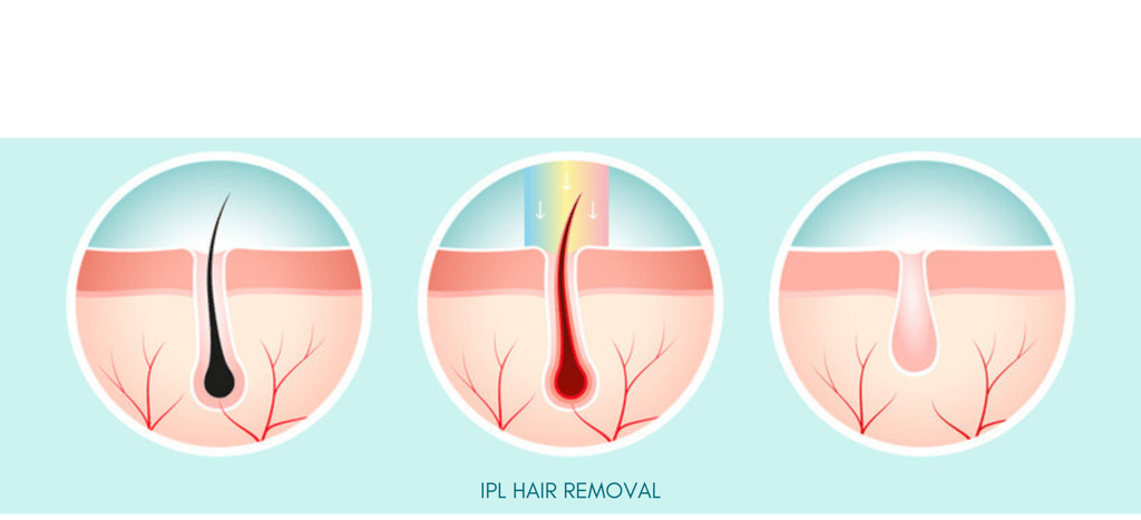 Laser Hair Removal
