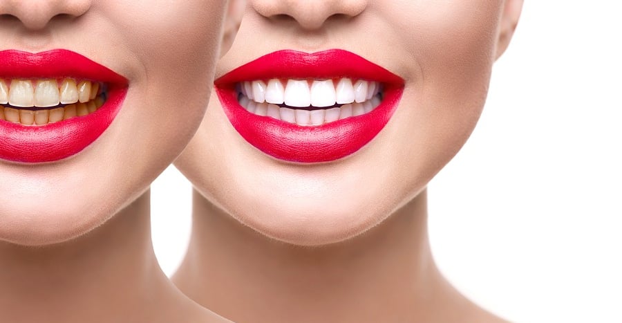 Best Teeth Whitening Service in Wadgaon sheri
