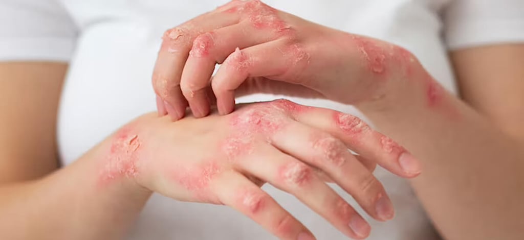 Herpes: