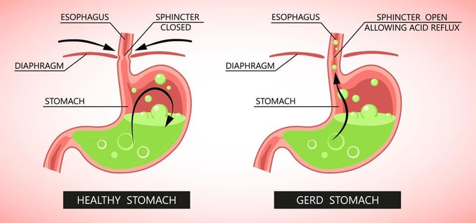 GERD stomach
