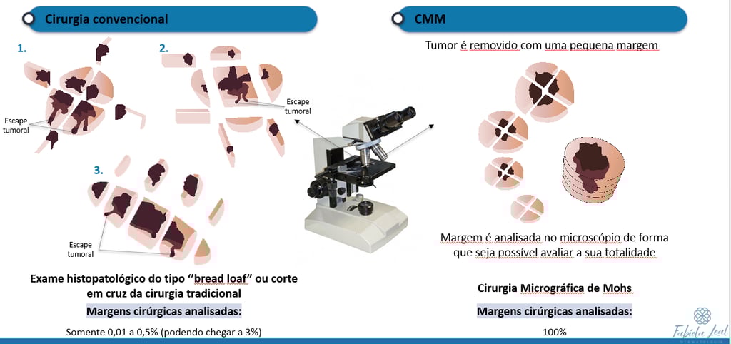 Comparação entre a avaliação de margens no exame por congelação e na cirurgia micrográfica de Mohs