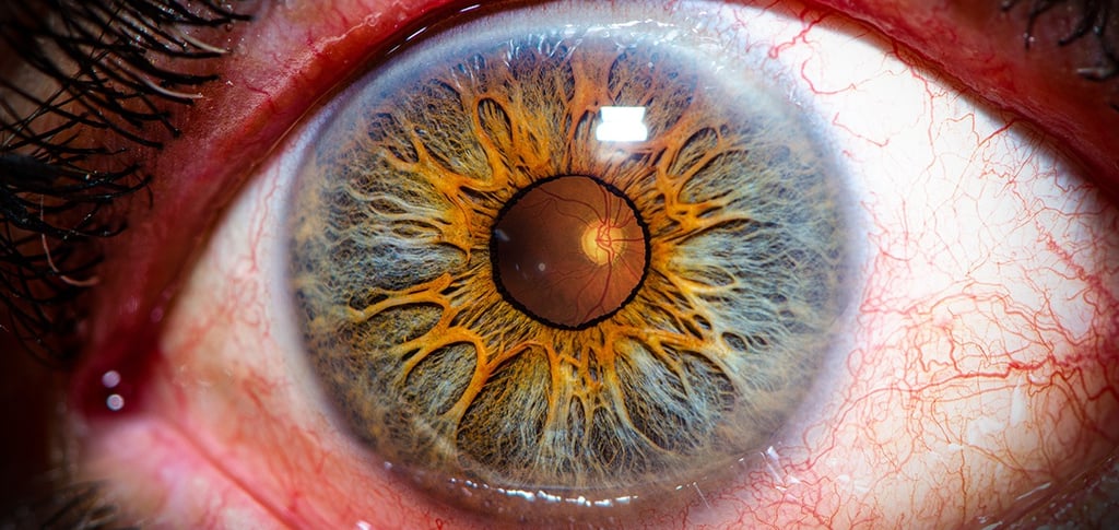 Foto de ojo con glaucoma