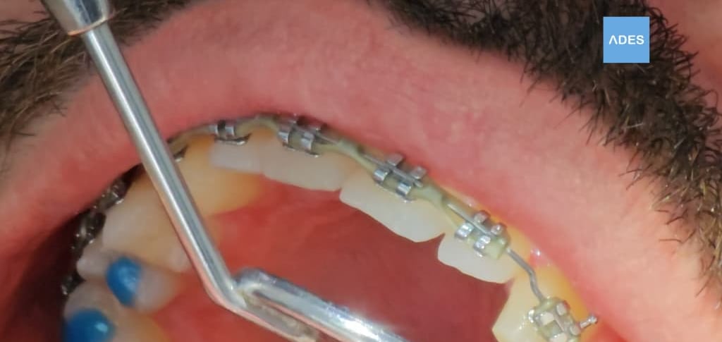 Tratamiento dental para adultos en Badajoz