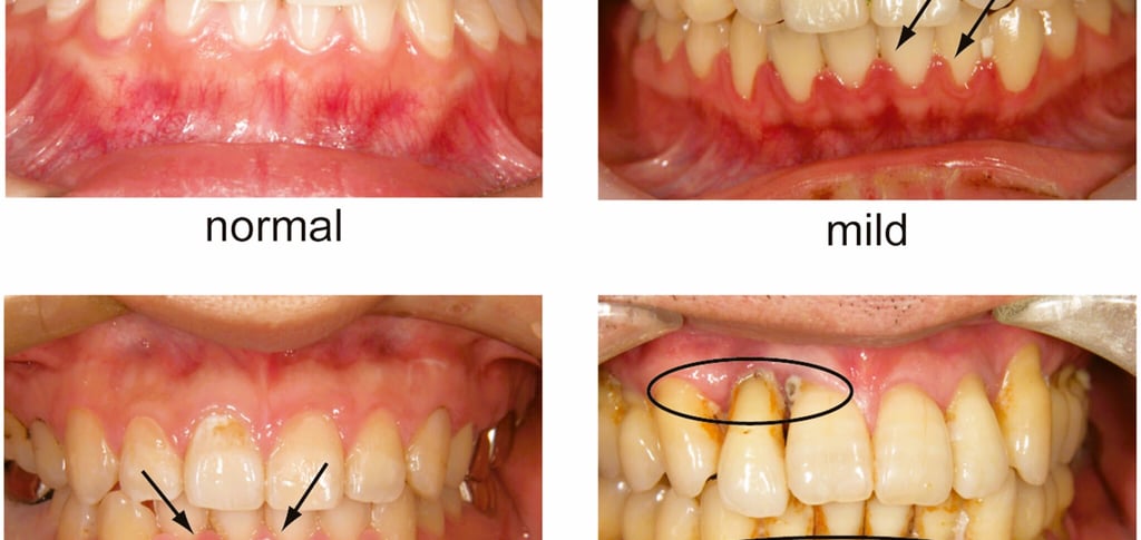 Periodontal disease