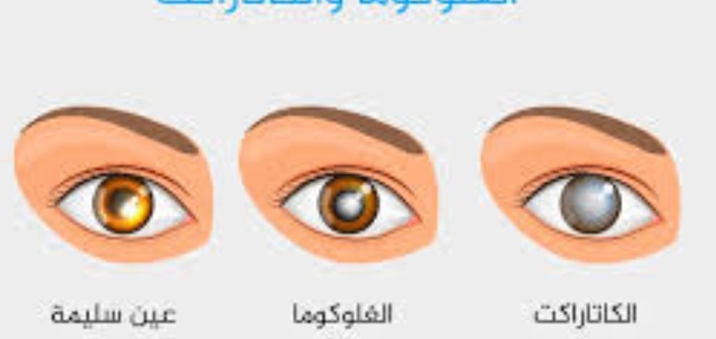 الجلوكوما : خيارات العلاج
