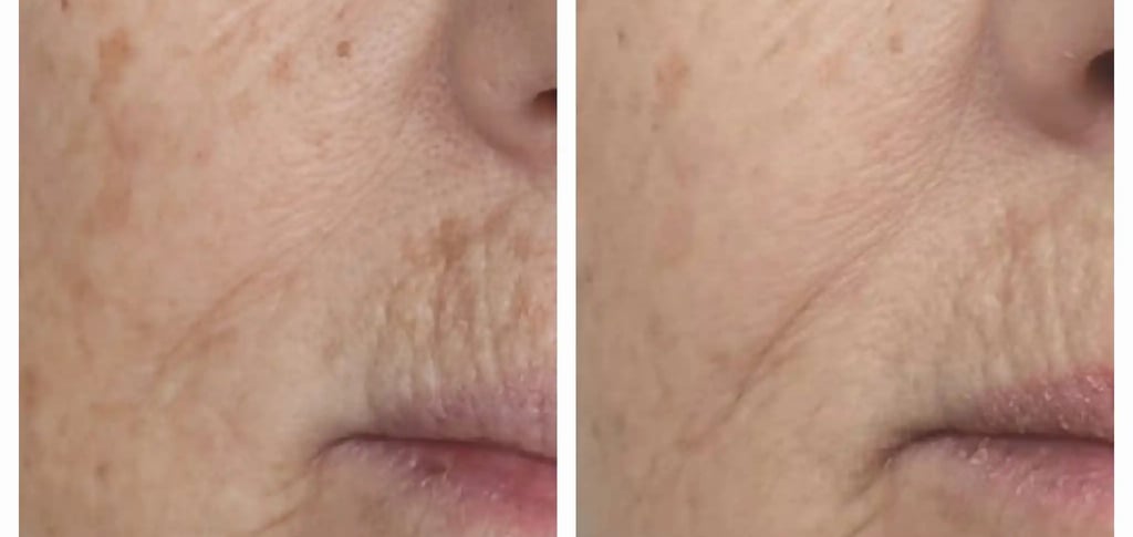 Before and after of treatment at Ariana Esthetic Edmonton