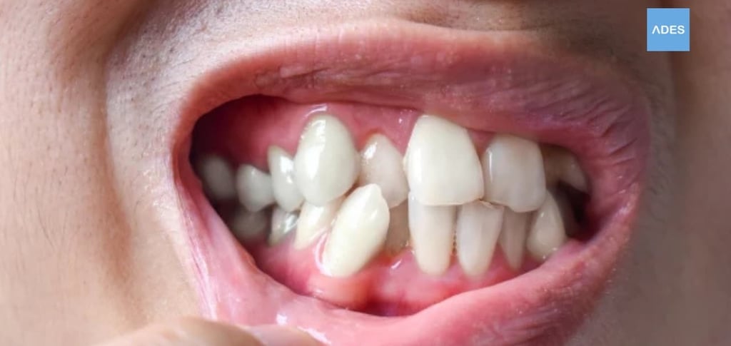 apinamiento dental