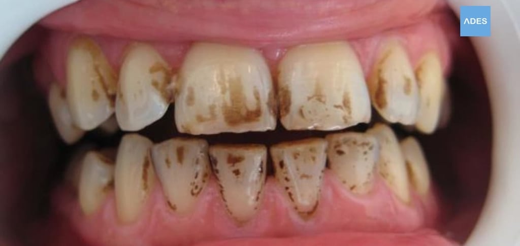 manchas dientes